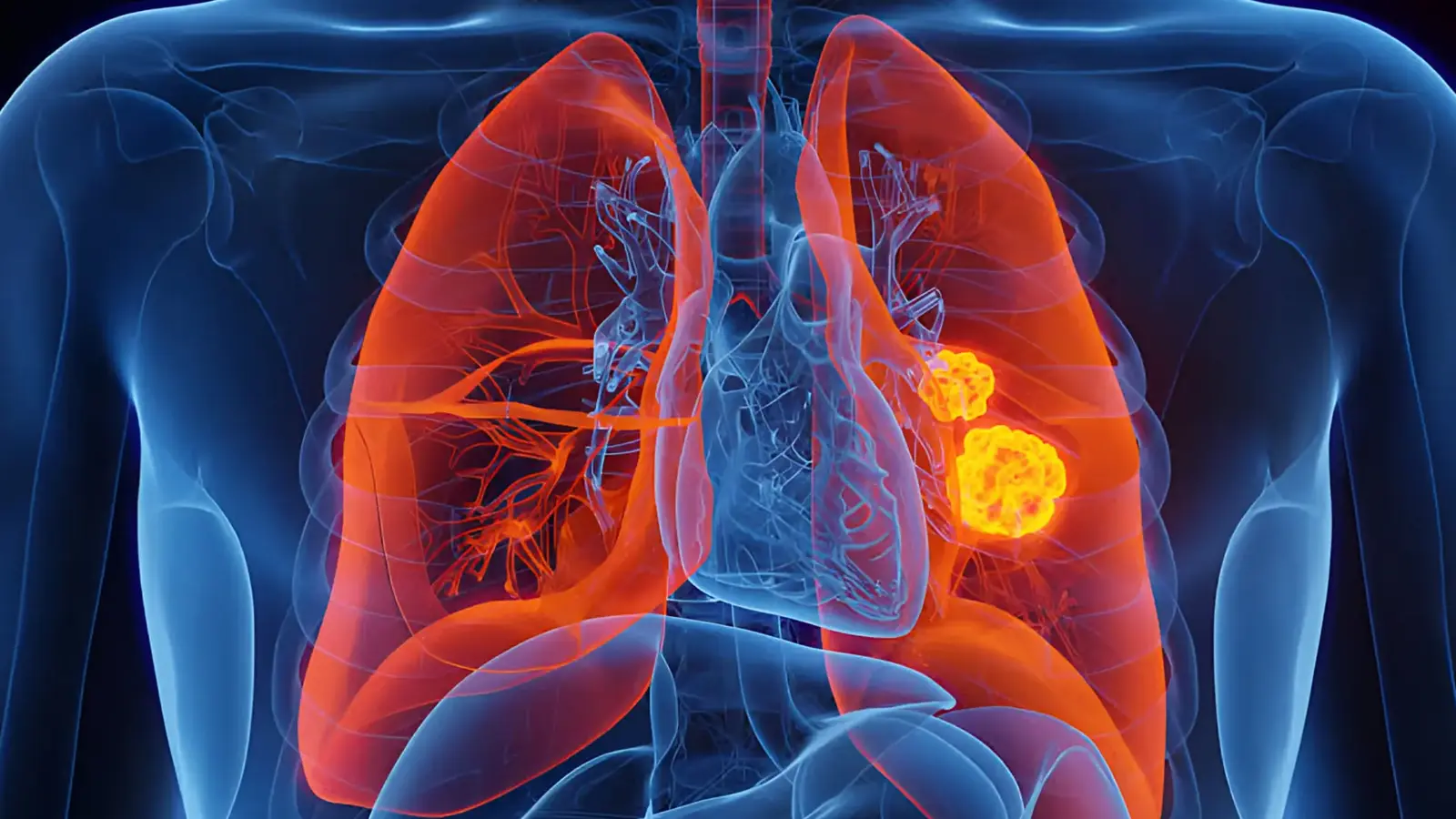 Rare EGFR Mutation Raises Lung Cancer Risk in Nonsmokers