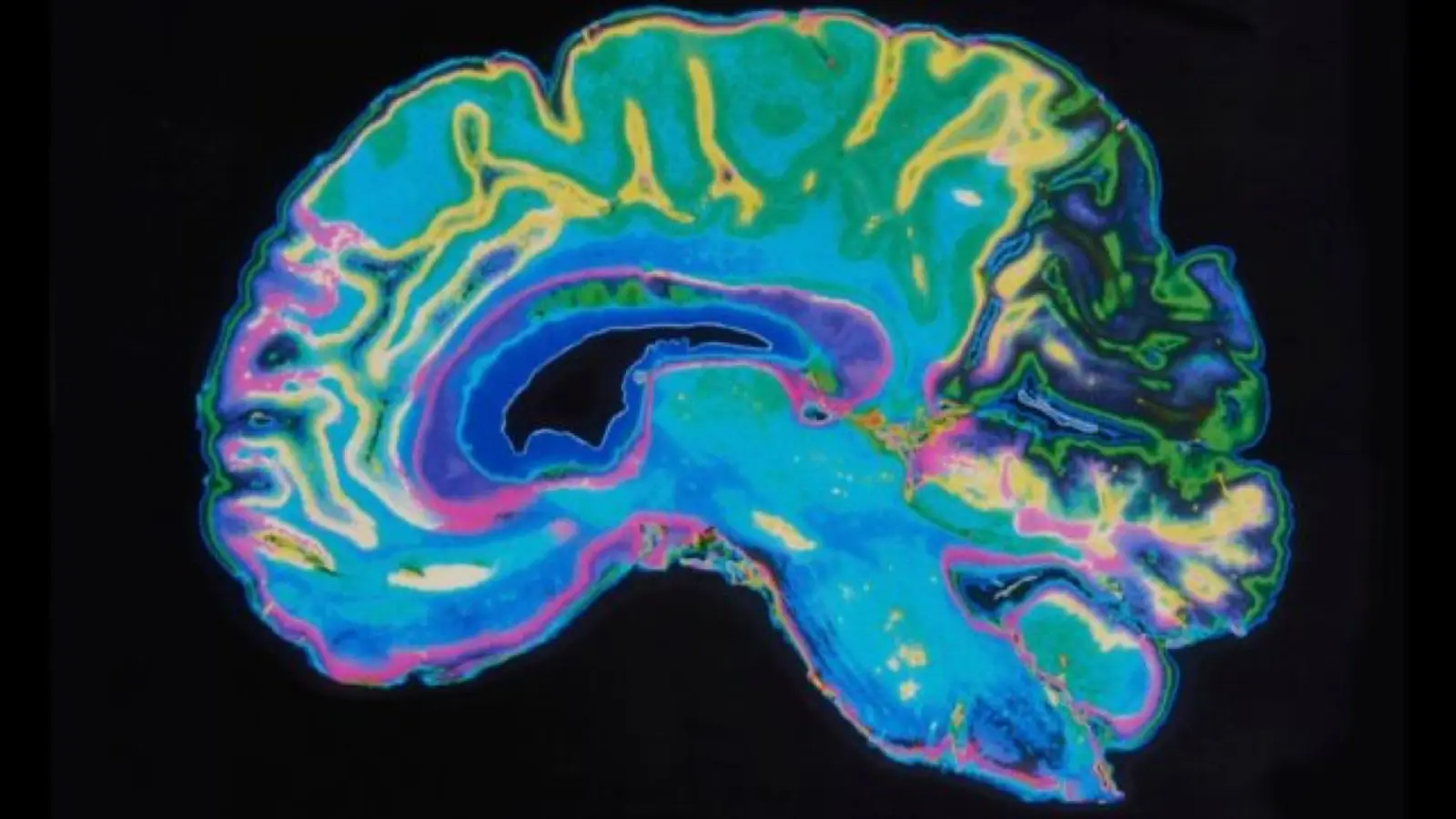 Menopause May Pause Age-Related Gray Matter Loss Temporarily