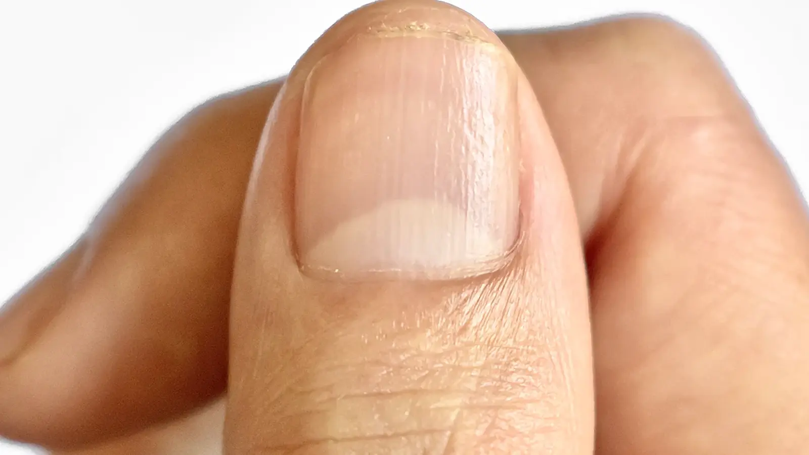 Why a Tiny Red Crescent on Your Nail Can Signal Disease