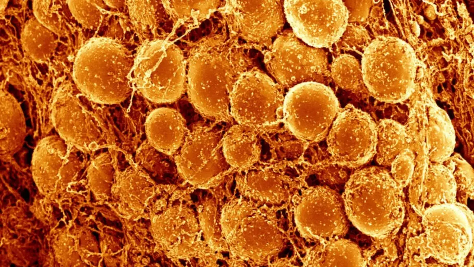 Brown Fat Cuts Heart Disease and Diabetes Risk in Adults