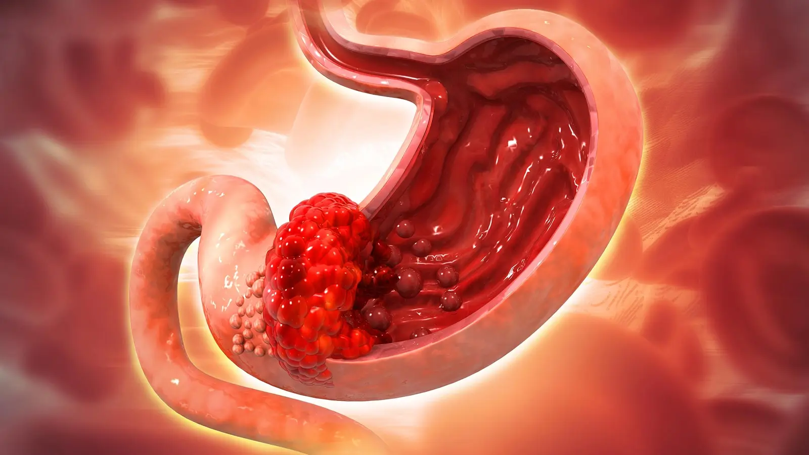 How a Common Stomach Bacterium Triggers Precancerous Change
